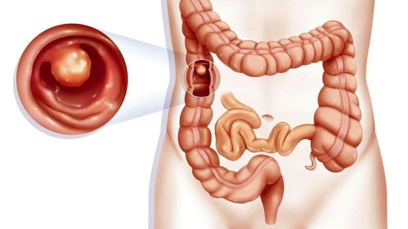  Polipi la stomac și colon. Ce ar trebui să știm.Ne spune gastroenterologul.