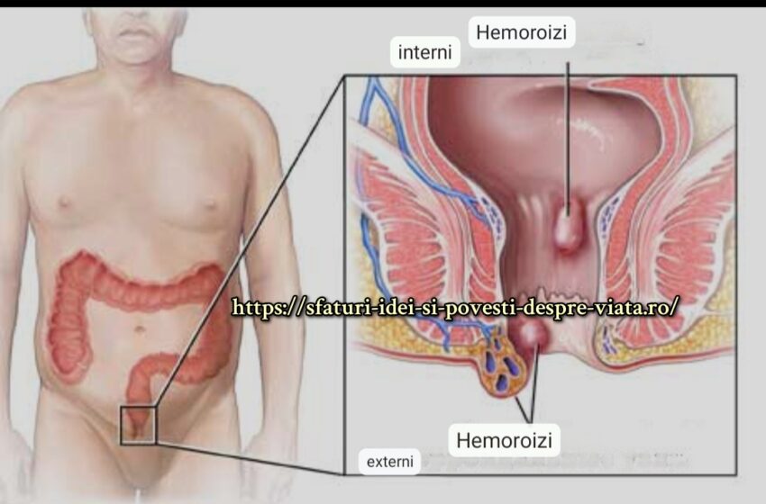  Metode naturale de tratare a hemoroizilor.