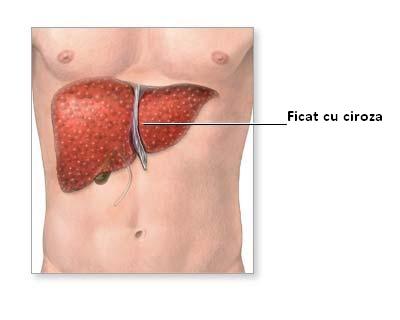  Remediu natural si incercat pentru CIROZA si ORICARE problema hepatică