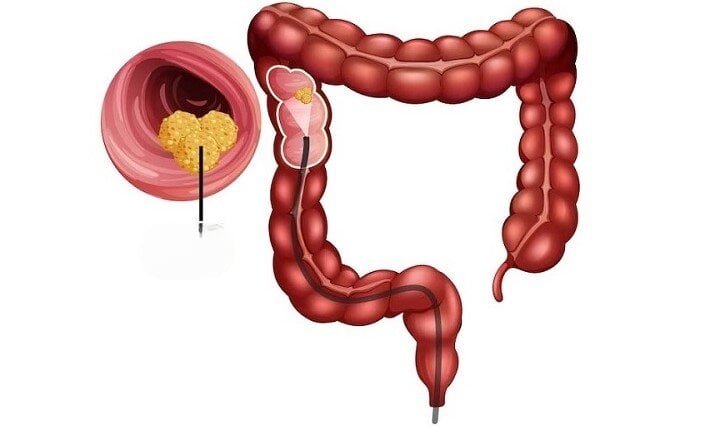  Cine este expus riscului de cancer de colon și cum  poate fi evitată boala?