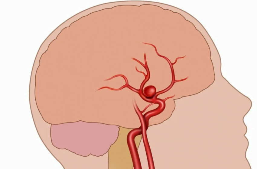  Cine are un risc mai mare de anevrism cerebral ?Un anevrism în vasele creierului este o bombă cu ceas: de ce este periculos?