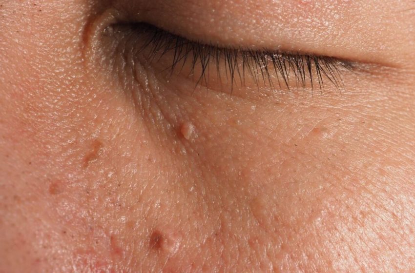  Tratamentul cancerului de piele cu remedii populare…