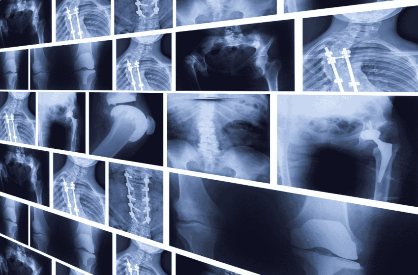  Ce poate diagnostica o radiografie toracică? Cum funcționează?