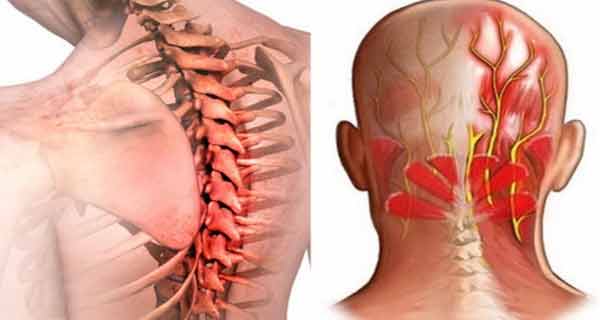  Nevralgie (nerv ciupit).Tipuri de nevralgie.Simptome de nevralgie.Tratamentul nevralgiei.