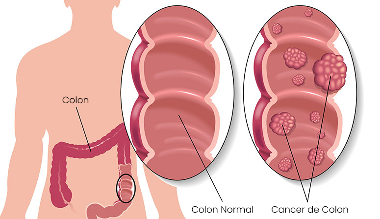  Răspunsuri despre cancerul colorectal de la un chirurg .Opțiuni de prevenire si simptome.