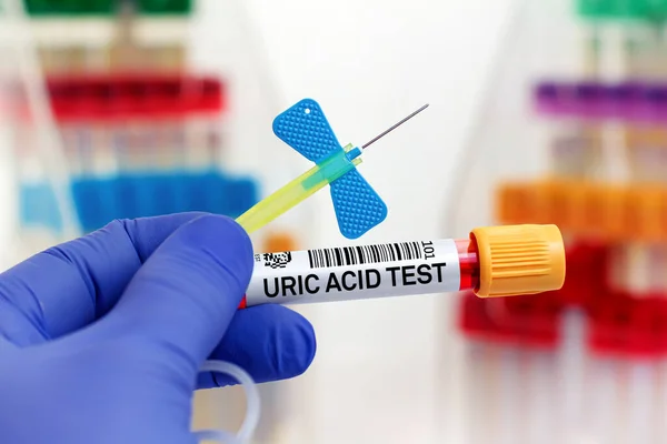  Testul de acid uric-La ce boli pot duce nivelurile ridicate sau scăzute de acid uric.