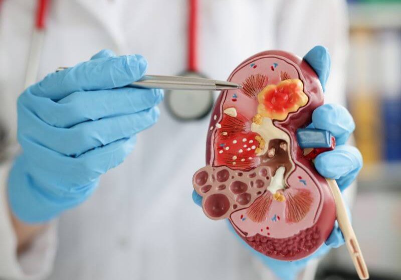  Pietrele ureterale sunt pietre la rinichi aflate într-unul dintre ureterele care leagă rinichiul de vezica urinară.Există patru tipuri principale de pietre ureterale.