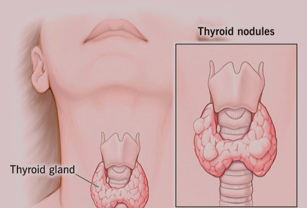  Noduli tiroidieni: metode naturale de tratare a acestora.