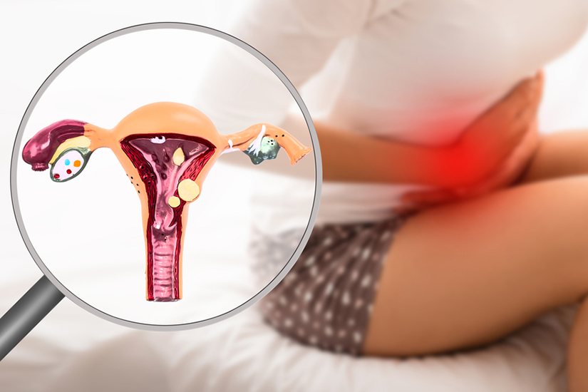  Endometrioza – Atenție, femei: Boala ascunsă și dureroasă a femeilor, care le tiranizează fără ca ele să știe – Vezi simptomele de bază.