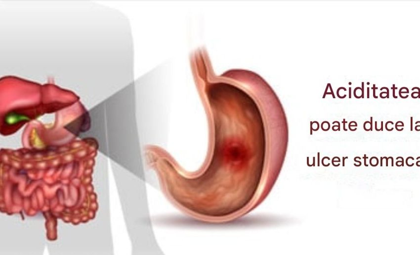  Aciditate – Cauze, Simptome, Diagnostic, Tratament și Complicații
