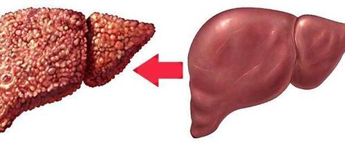  Hepatoza hepatică tratata cu remedii naturale.