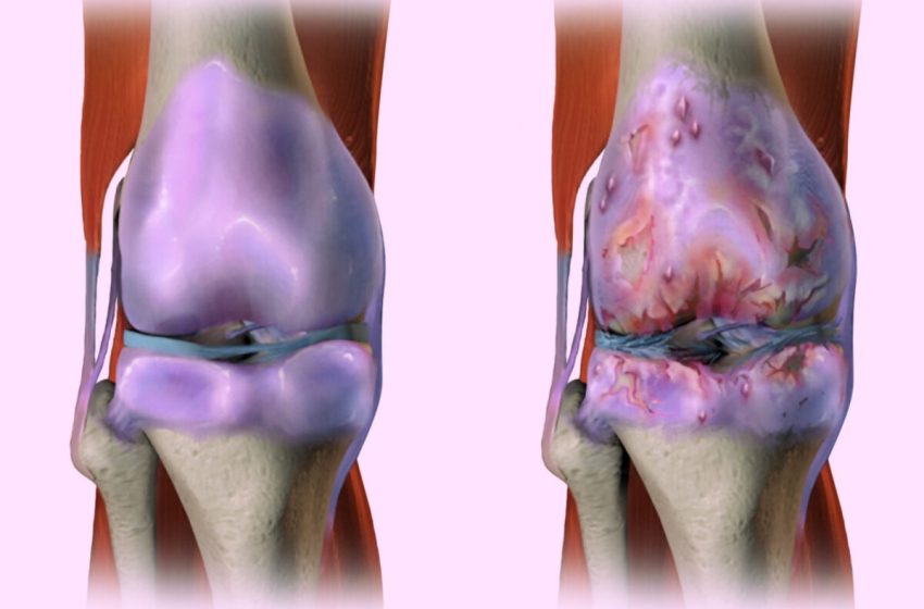  Remedii naturale dovedite pentru osteoartrita de genunchi și durerile articulare
