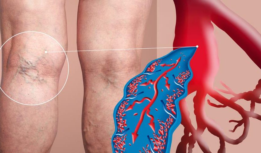  Remedii naturiste pentru tromboflebita ,dureri articulare și musculare la nivelul picioarelor și umflături la nivelul extremităților inferioare.