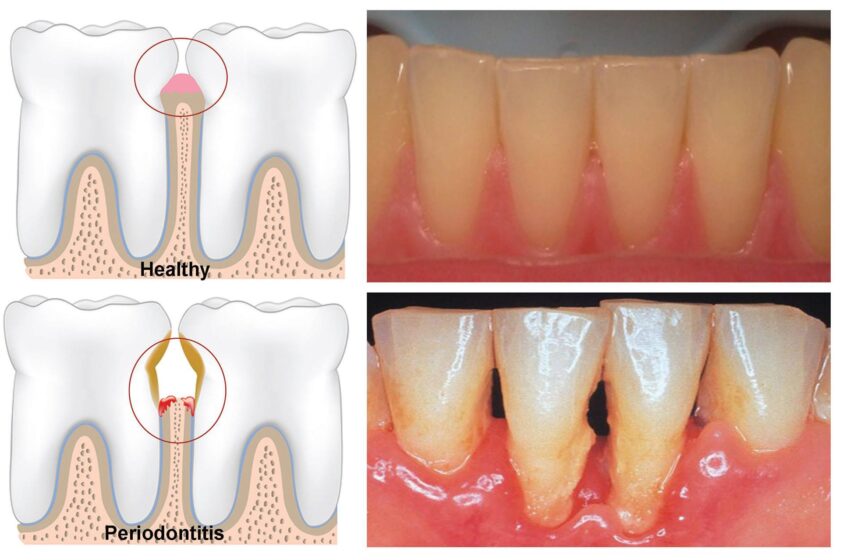  Masajul gingiilor pentru boala parodontală si remedii populare pentru bolile paradontale.