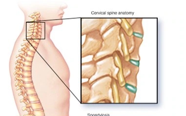  Spondiloza cervicală.Simptome.Cauze.Factori de risc.Teste imagistice.