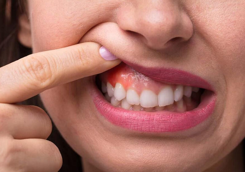  Sângerări gingivale. De ce sângerează gingiile? Cum se trateaza gingiile la medic sau acasa.