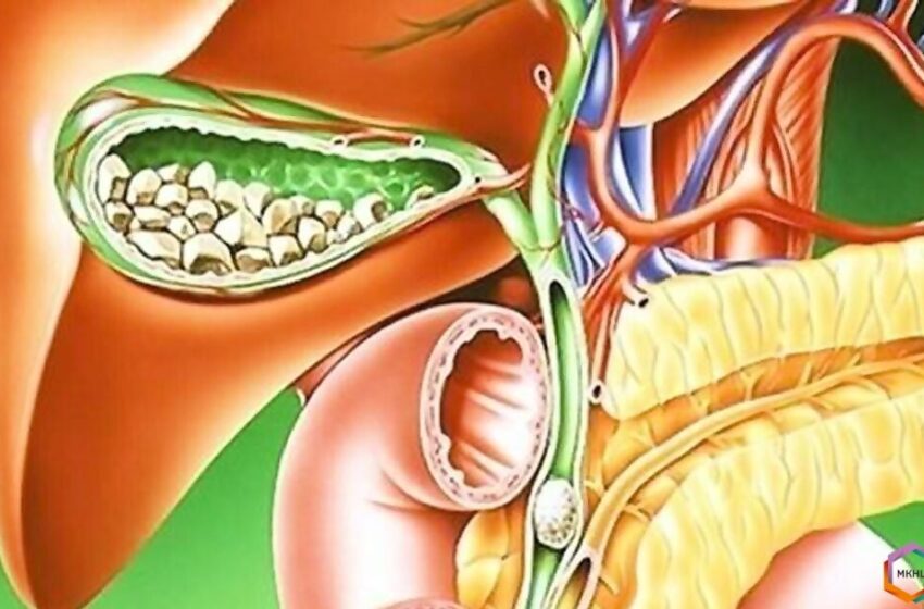  Calculi biliari și pancreatită: cum să recunoaștem pericolul și să salvăm pancreasul