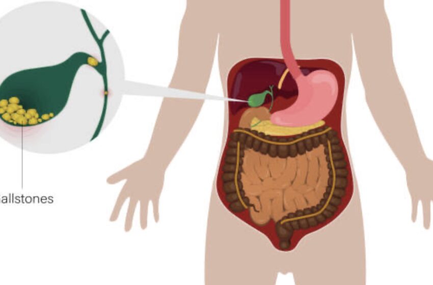  Cateva retete folositoare pentru eliminarea pietrelor de  la vezica biliară.