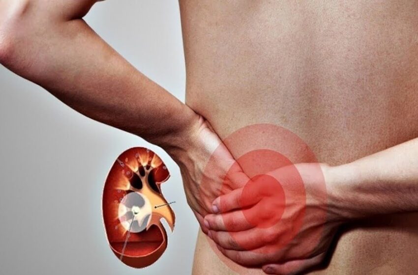  Cele 5 tipuri de durere care avertizează asupra unei probleme renale avansate.