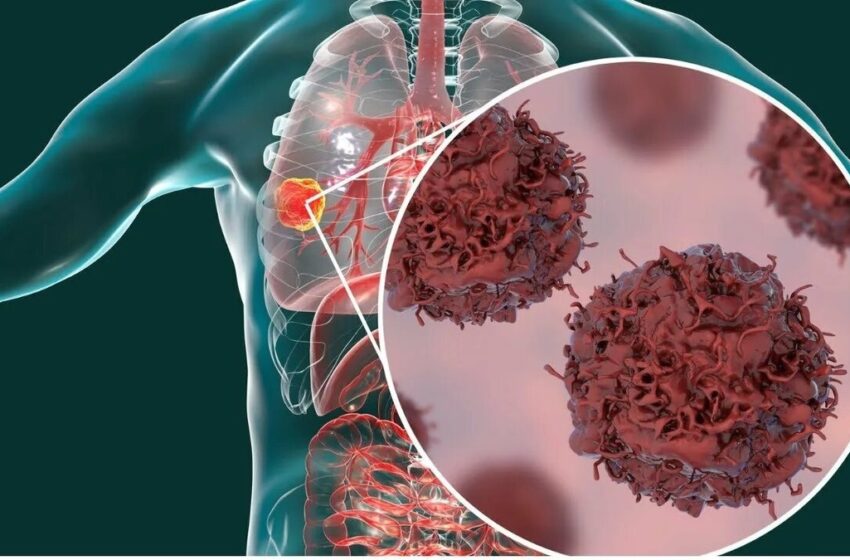  Principalul secret al metastazelor: cum activează hipoxia răspândirea tumorii.