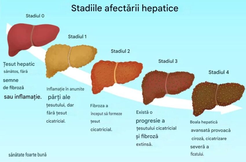  Semne de afectare hepatică în stadii incipiente și avansate
