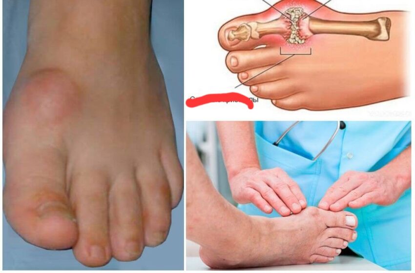  Remedii naturale pentru depunerile de sare.Depunerile de sare din articulații sunt excrescențe osoase cauzate de gută, osteocondroză sau artroză 